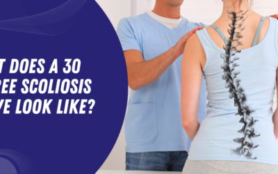 What Does a 30 Degree Scoliosis Curve Look Like?