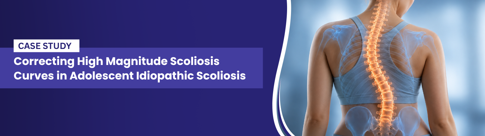 Correcting High Magnitude Scoliosis Curves in Adolescent Idiopathic Scoliosis | drarvindumarani.in