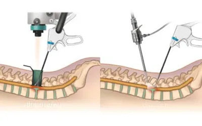 H1_Image Biportal Endoscopic Spine Surgery | drarvindumarani.in