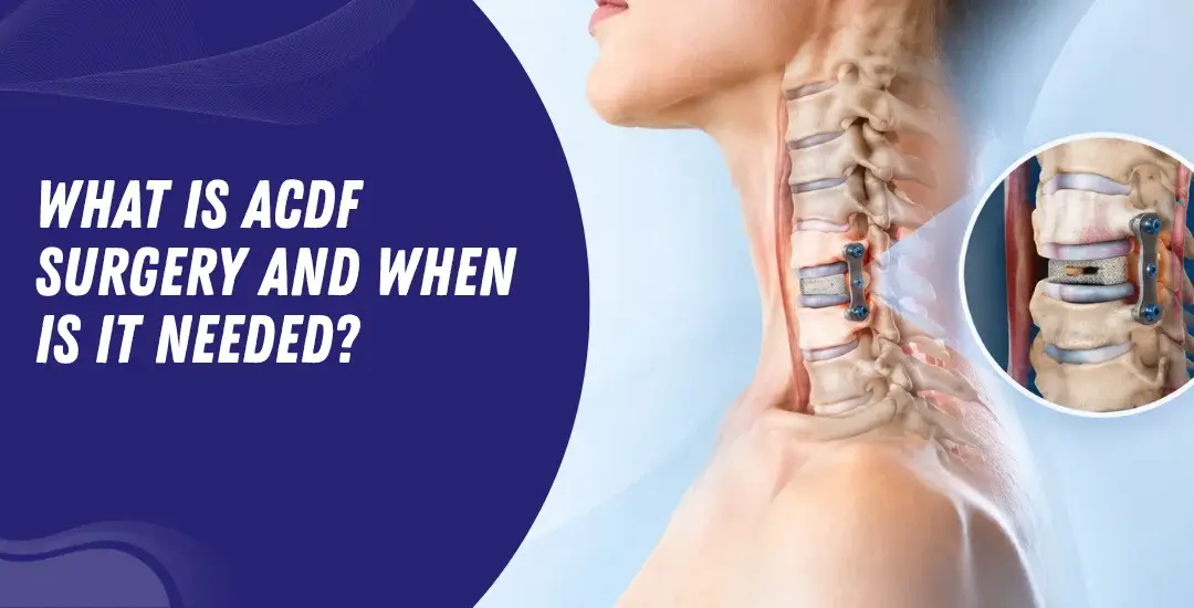 What is ACDF surgery and when is it needed