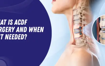 What Is ACDF Surgery and When Is It Needed?
